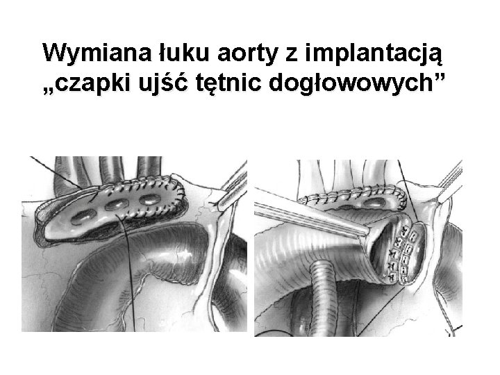 Wymiana łuku aorty z implantacją „czapki ujść tętnic dogłowowych” Wymiana łuku aorty z implantacją „czapki ujść tętnic dogłowowych”