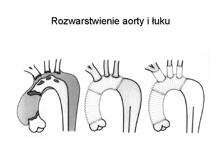 Rozwarstwienie aorty i łuku Rozwarstwienie aorty i łuku