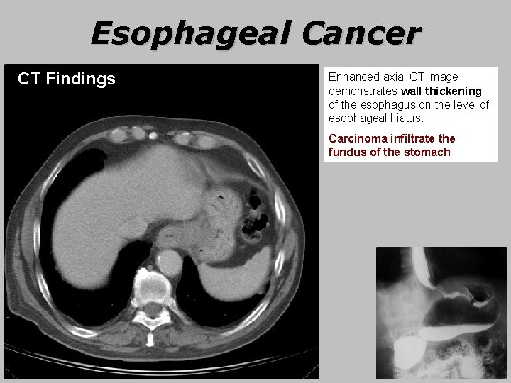 Esophageal Cancer CT Findings Enhanced axial CT image demonstrates wall thickening of the esophagus