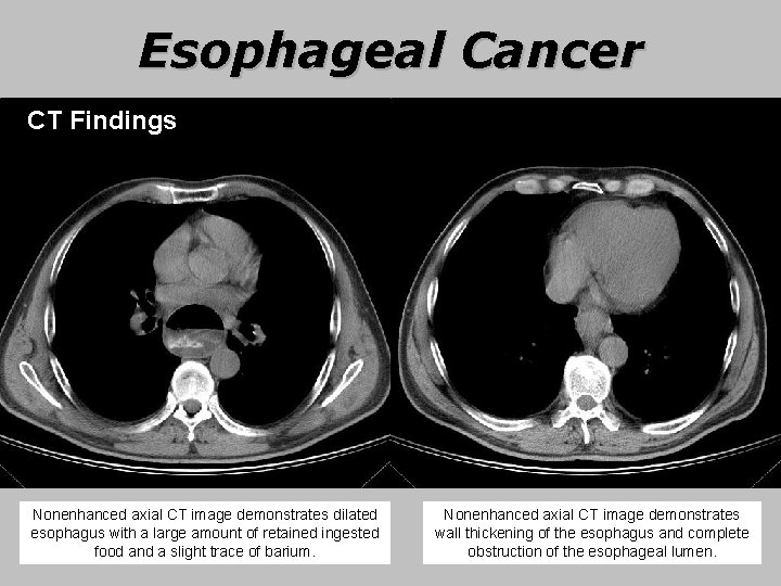 Esophageal Cancer CT Findings Nonenhanced axial CT image demonstrates dilated esophagus with a large