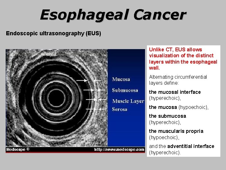 Esophageal Cancer Endoscopic ultrasonography (EUS) Unlike CT, EUS allows visualization of the distinct layers