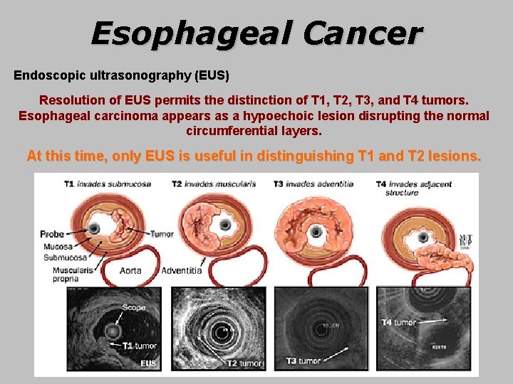 Esophageal Cancer Endoscopic ultrasonography (EUS) Resolution of EUS permits the distinction of T 1,