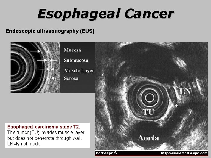 Esophageal Cancer Endoscopic ultrasonography (EUS) Esophageal carcinoma stage T 2. The tumor (TU) invades