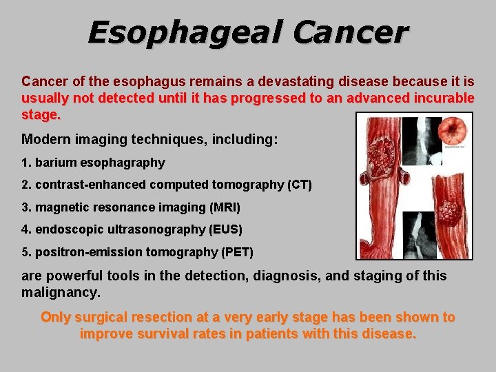 Esophageal Cancer of the esophagus remains a devastating disease because it is usually not