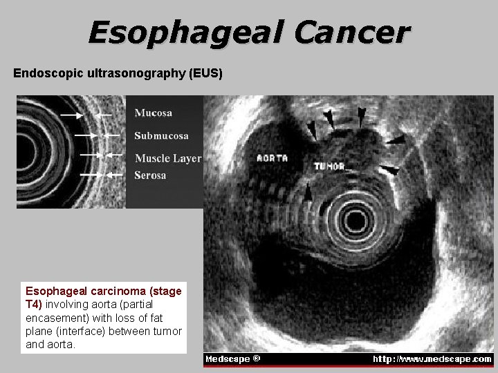 Esophageal Cancer Endoscopic ultrasonography (EUS) Esophageal carcinoma (stage T 4) involving aorta (partial encasement)