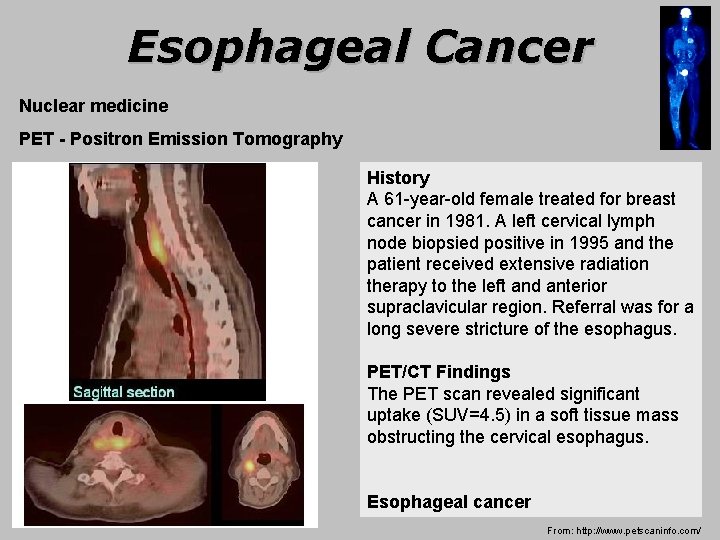 Esophageal Cancer Nuclear medicine PET - Positron Emission Tomography History A 61 -year-old female