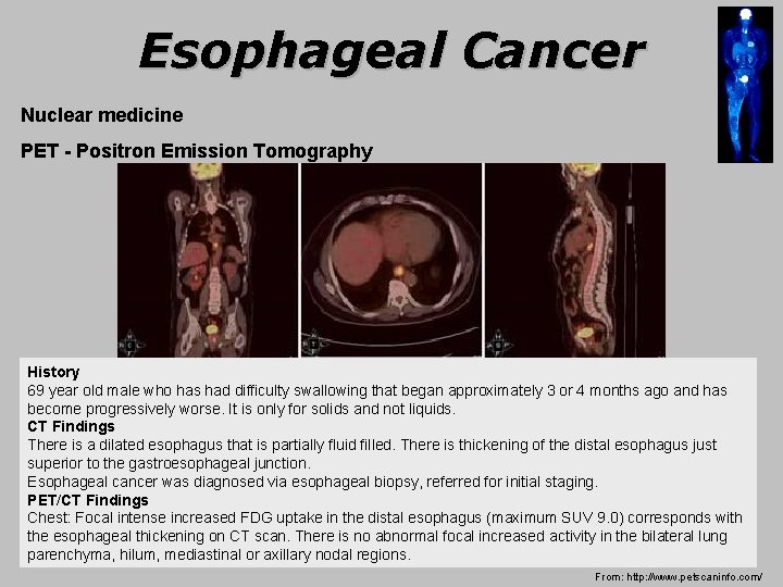 Esophageal Cancer Nuclear medicine PET - Positron Emission Tomography History 69 year old male