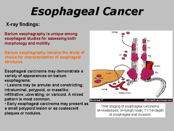 Esophageal Cancer X-ray findings: Barium esophagraphy is unique among esophageal studies for assessing both