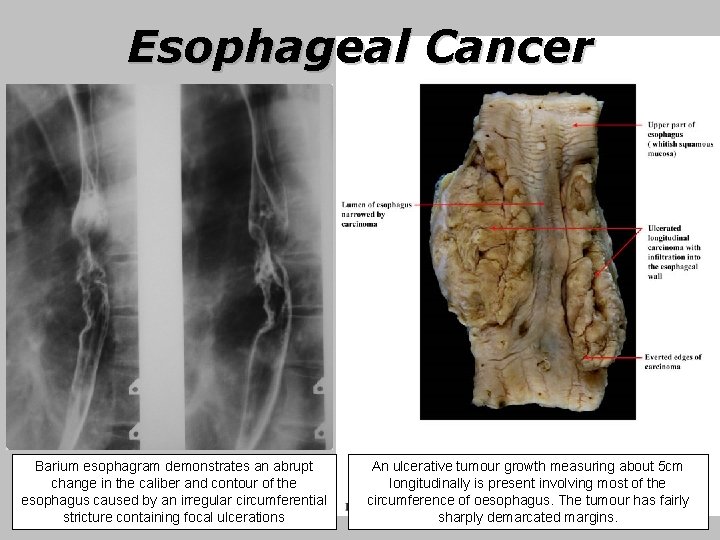 Esophageal Cancer Barium esophagram demonstrates an abrupt change in the caliber and contour of