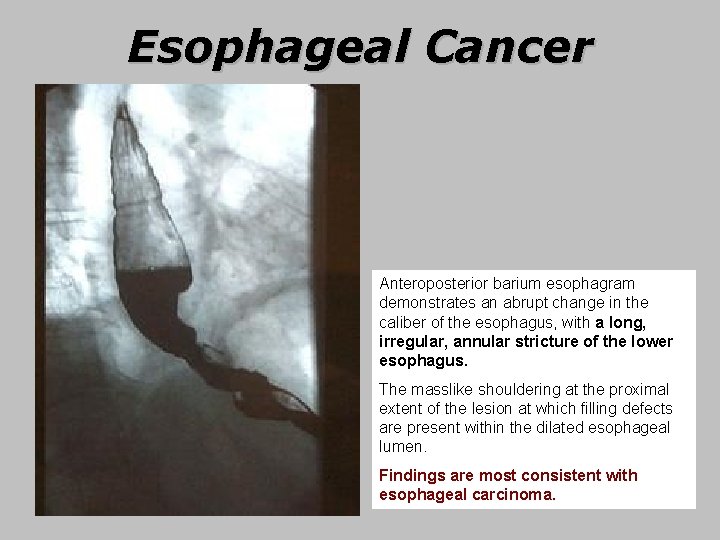 Esophageal Cancer Anteroposterior barium esophagram demonstrates an abrupt change in the caliber of the