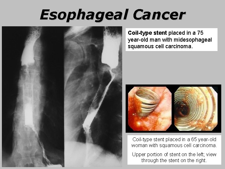 Esophageal Cancer Coil-type stent placed in a 75 year-old man with midesophageal squamous cell