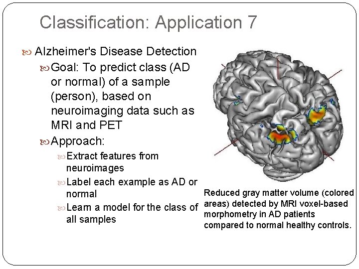 Classification: Application 7 Alzheimer's Disease Detection Goal: To predict class (AD or normal) of