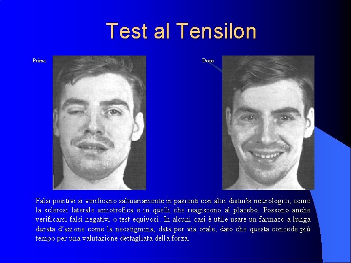 Test al Tensilon Prima Dopo Falsi positivi si verificano saltuariamente in pazienti con altri