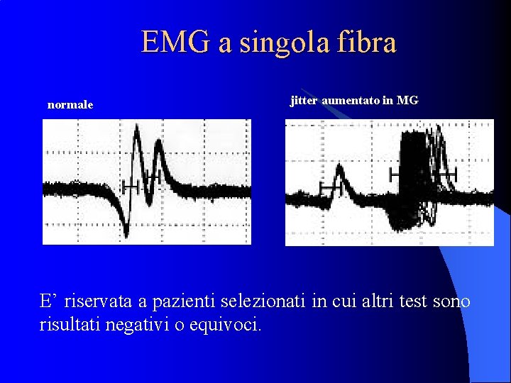 EMG a singola fibra normale jitter aumentato in MG E’ riservata a pazienti selezionati