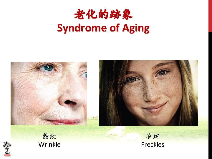 老化的跡象 Syndrome of Aging 皺紋 Wrinkle 雀斑 Freckles 老化的跡象 Syndrome of Aging 皺紋 Wrinkle 雀斑 Freckles