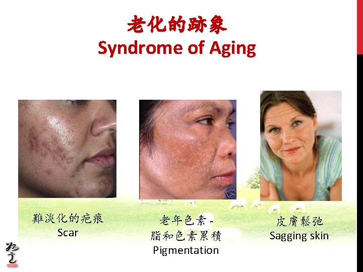 老化的跡象 Syndrome of Aging 難淡化的疤痕 Scar 老年色素 脂和色素累積 Pigmentation 皮膚鬆弛 Sagging skin 