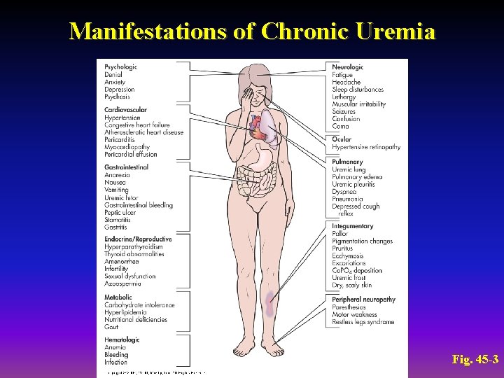 Uremia diabetică