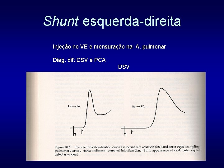 Shunt esquerda-direita Injeção no VE e mensuração na A. pulmonar Diag. dif: DSV e