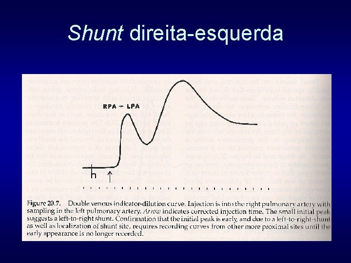 Shunt direita-esquerda 