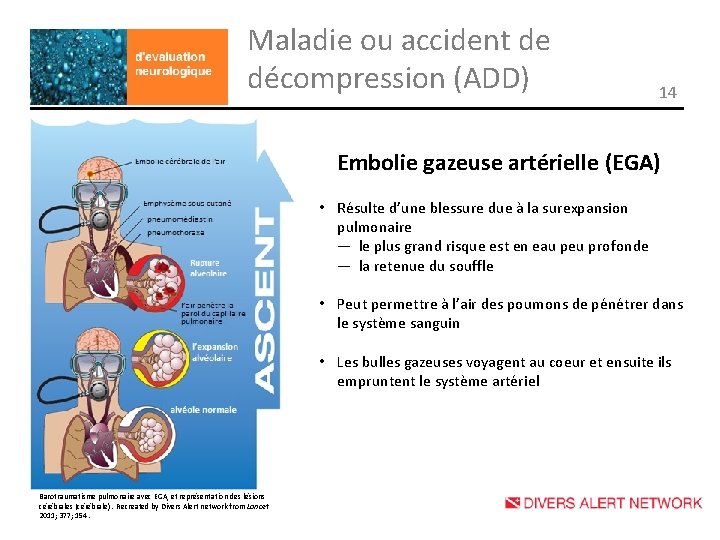 Maladie ou accident de décompression (ADD) 14 Embolie gazeuse artérielle (EGA) • Résulte d’une