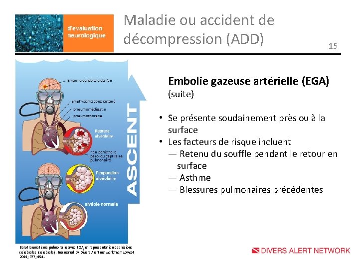 Maladie ou accident de décompression (ADD) 15 Embolie gazeuse artérielle (EGA) (suite) • Se