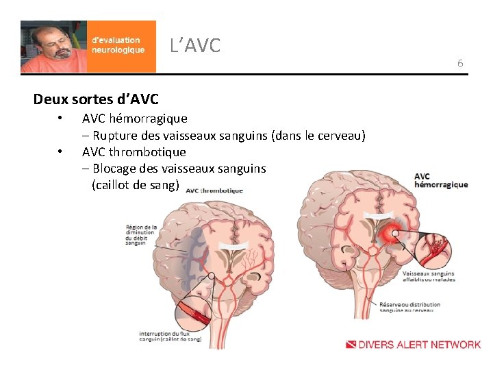 L’AVC Deux sortes d’AVC • • AVC hémorragique – Rupture des vaisseaux sanguins (dans