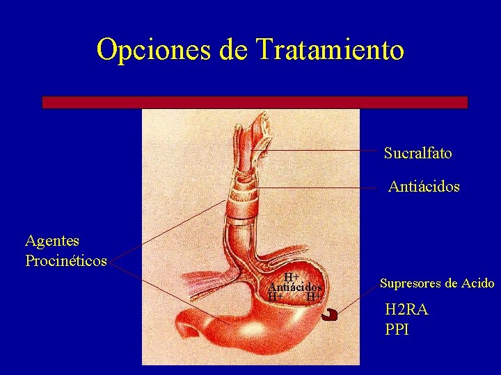 Opciones de Tratamiento Sucralfato Antiácidos Agentes Procinéticos H+ Antiácidos H+ H+ Supresores de Acido