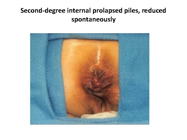 Second-degree internal prolapsed piles, reduced spontaneously 