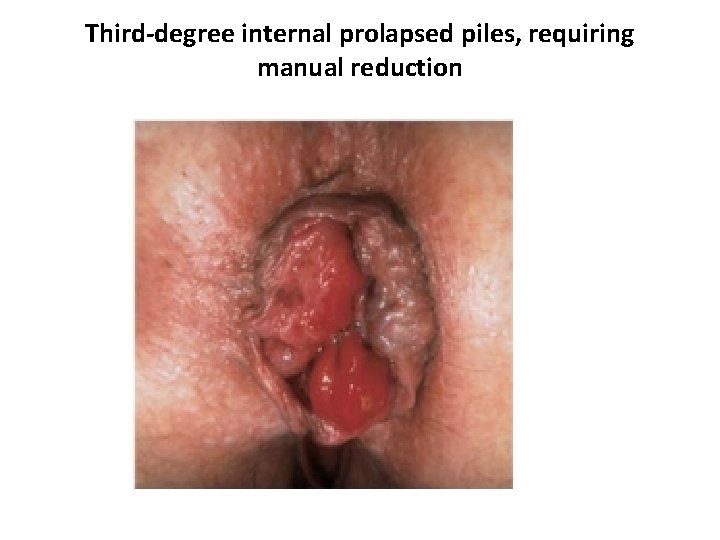 Third-degree internal prolapsed piles, requiring manual reduction 