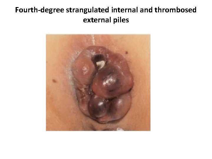 Fourth-degree strangulated internal and thrombosed external piles 
