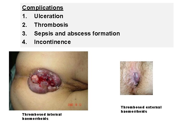 Complications 1. Ulceration 2. Thrombosis 3. Sepsis and abscess formation 4. Incontinence Thrombosed internal