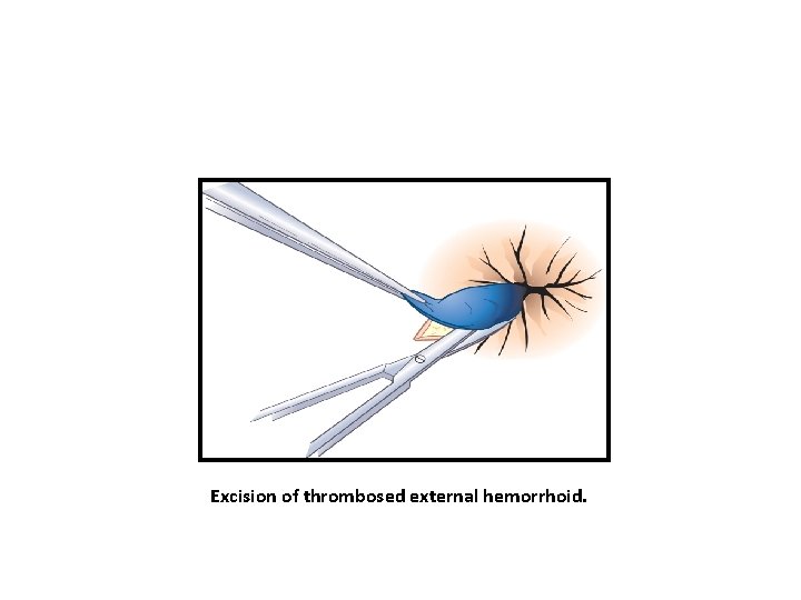 Excision of thrombosed external hemorrhoid. 
