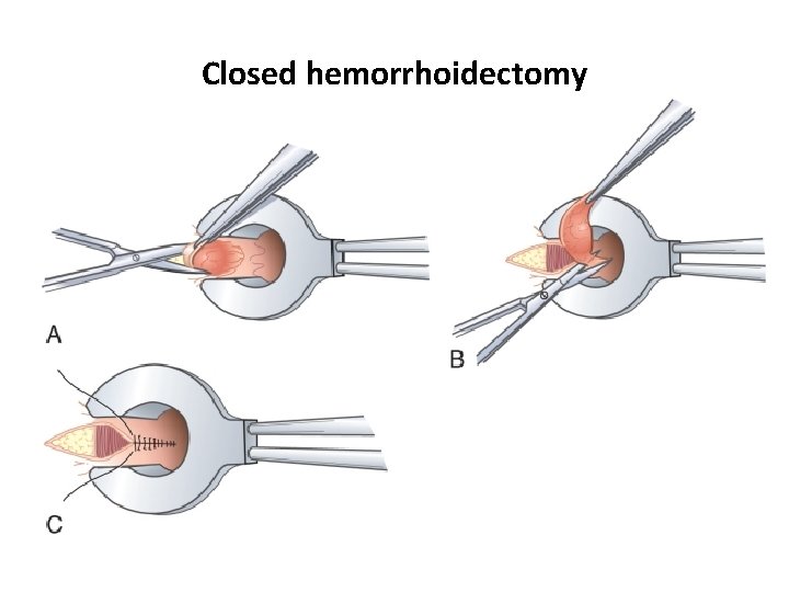 Closed hemorrhoidectomy 