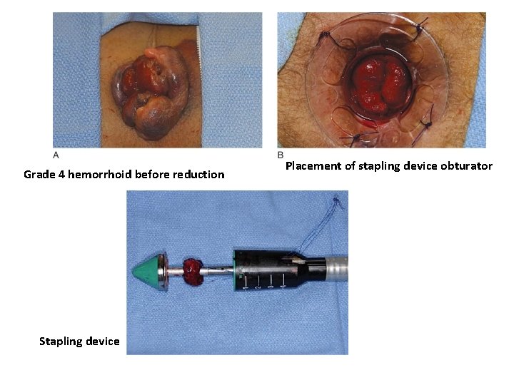 Grade 4 hemorrhoid before reduction Stapling device Placement of stapling device obturator 