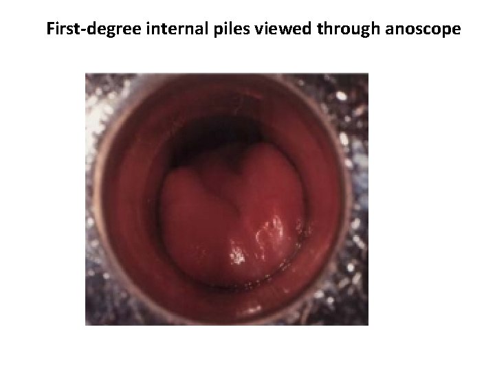 First-degree internal piles viewed through anoscope 