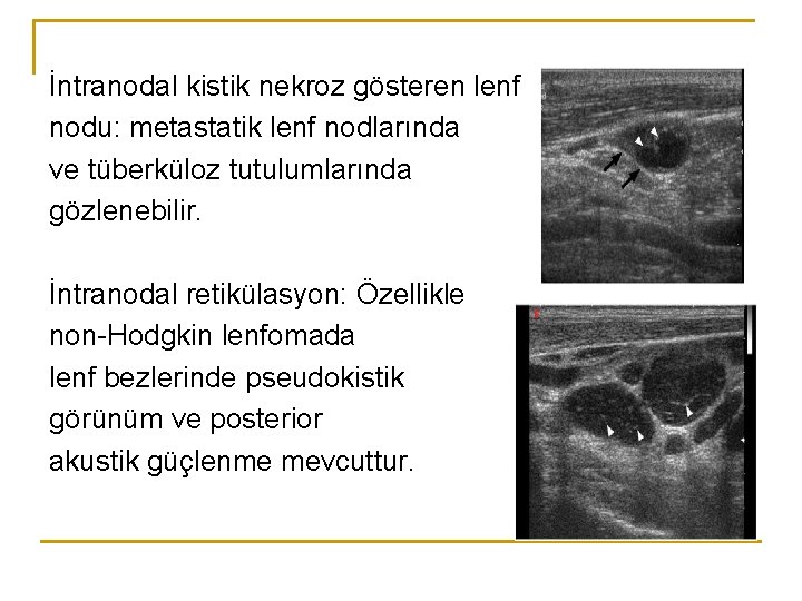 İntranodal kistik nekroz gösteren lenf nodu: metastatik lenf nodlarında ve tüberküloz tutulumlarında gözlenebilir. İntranodal İntranodal kistik nekroz gösteren lenf nodu: metastatik lenf nodlarında ve tüberküloz tutulumlarında gözlenebilir. İntranodal