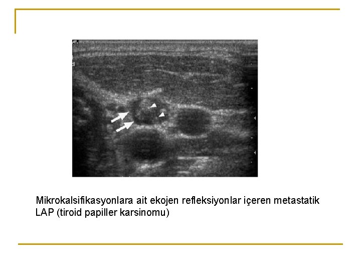Mikrokalsifikasyonlara ait ekojen refleksiyonlar içeren metastatik LAP (tiroid papiller karsinomu) Mikrokalsifikasyonlara ait ekojen refleksiyonlar içeren metastatik LAP (tiroid papiller karsinomu)