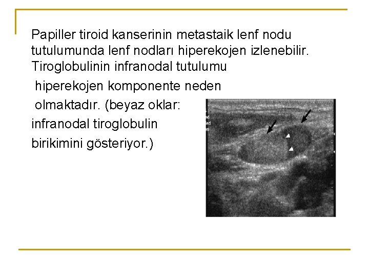 Papiller tiroid kanserinin metastaik lenf nodu tutulumunda lenf nodları hiperekojen izlenebilir. Tiroglobulinin infranodal tutulumu Papiller tiroid kanserinin metastaik lenf nodu tutulumunda lenf nodları hiperekojen izlenebilir. Tiroglobulinin infranodal tutulumu