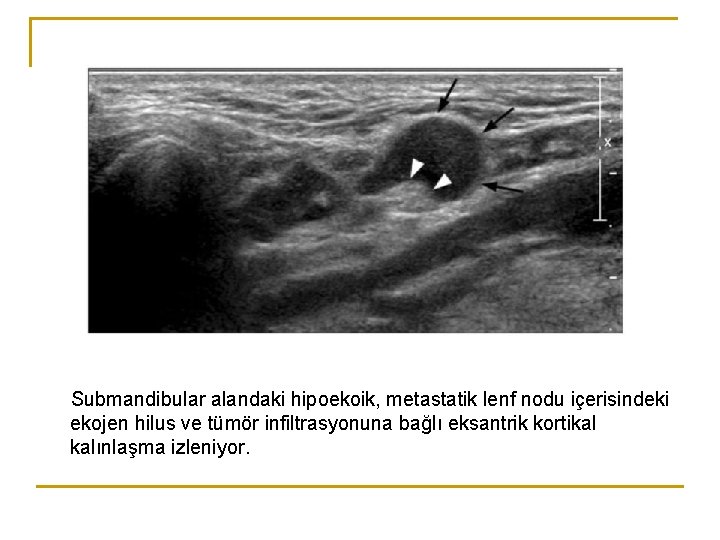 Submandibular alandaki hipoekoik, metastatik lenf nodu içerisindeki ekojen hilus ve tümör infiltrasyonuna bağlı eksantrik Submandibular alandaki hipoekoik, metastatik lenf nodu içerisindeki ekojen hilus ve tümör infiltrasyonuna bağlı eksantrik