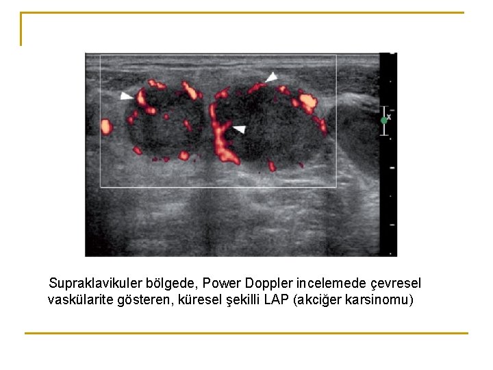 Supraklavikuler bölgede, Power Doppler incelemede çevresel vaskülarite gösteren, küresel şekilli LAP (akciğer karsinomu) Supraklavikuler bölgede, Power Doppler incelemede çevresel vaskülarite gösteren, küresel şekilli LAP (akciğer karsinomu)