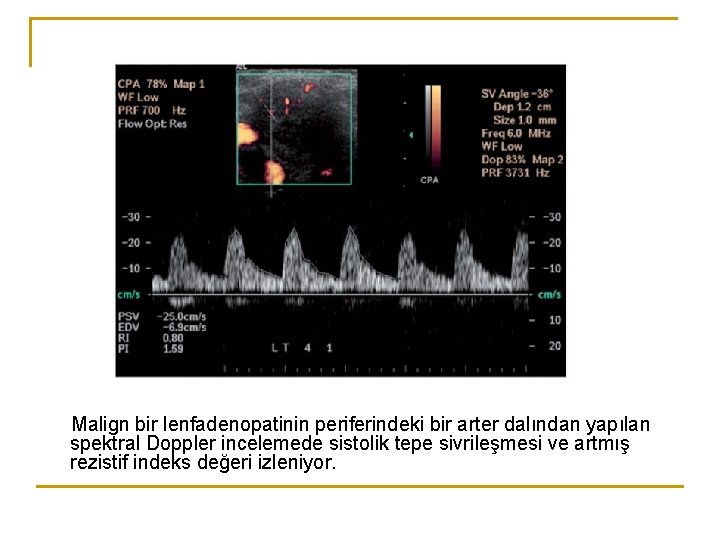 Malign bir lenfadenopatinin periferindeki bir arter dalından yapılan spektral Doppler incelemede sistolik tepe sivrileşmesi Malign bir lenfadenopatinin periferindeki bir arter dalından yapılan spektral Doppler incelemede sistolik tepe sivrileşmesi