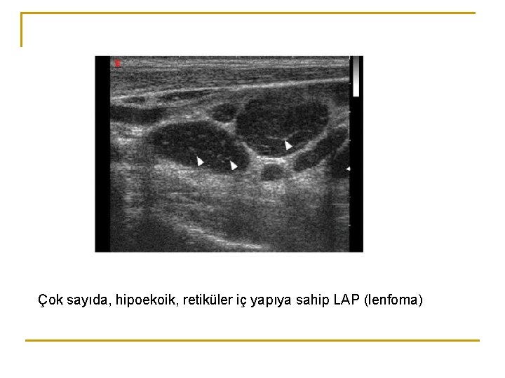 Çok sayıda, hipoekoik, retiküler iç yapıya sahip LAP (lenfoma) Çok sayıda, hipoekoik, retiküler iç yapıya sahip LAP (lenfoma)
