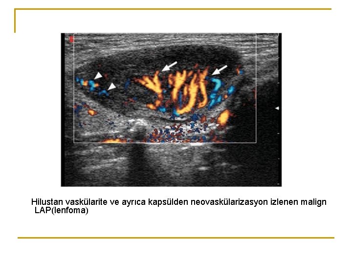 Hilustan vaskülarite ve ayrıca kapsülden neovaskülarizasyon izlenen malign LAP(lenfoma) Hilustan vaskülarite ve ayrıca kapsülden neovaskülarizasyon izlenen malign LAP(lenfoma)