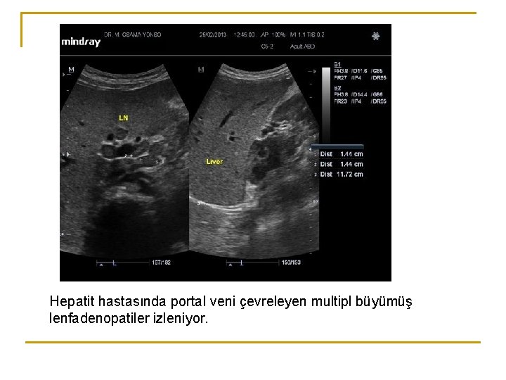 Hepatit hastasında portal veni çevreleyen multipl büyümüş lenfadenopatiler izleniyor. Hepatit hastasında portal veni çevreleyen multipl büyümüş lenfadenopatiler izleniyor.