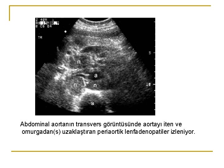 Abdominal aortanın transvers görüntüsünde aortayı iten ve omurgadan(s) uzaklaştıran periaortik lenfadenopatiler izleniyor. Abdominal aortanın transvers görüntüsünde aortayı iten ve omurgadan(s) uzaklaştıran periaortik lenfadenopatiler izleniyor.