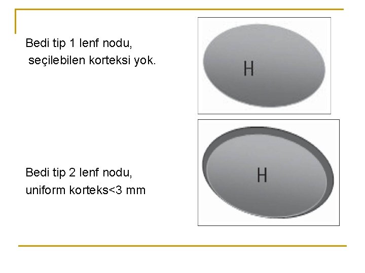Bedi tip 1 lenf nodu, seçilebilen korteksi yok. Bedi tip 2 lenf nodu, uniform Bedi tip 1 lenf nodu, seçilebilen korteksi yok. Bedi tip 2 lenf nodu, uniform