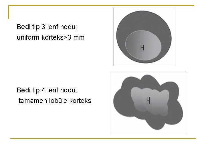 Bedi tip 3 lenf nodu; uniform korteks>3 mm Bedi tip 4 lenf nodu; tamamen Bedi tip 3 lenf nodu; uniform korteks>3 mm Bedi tip 4 lenf nodu; tamamen