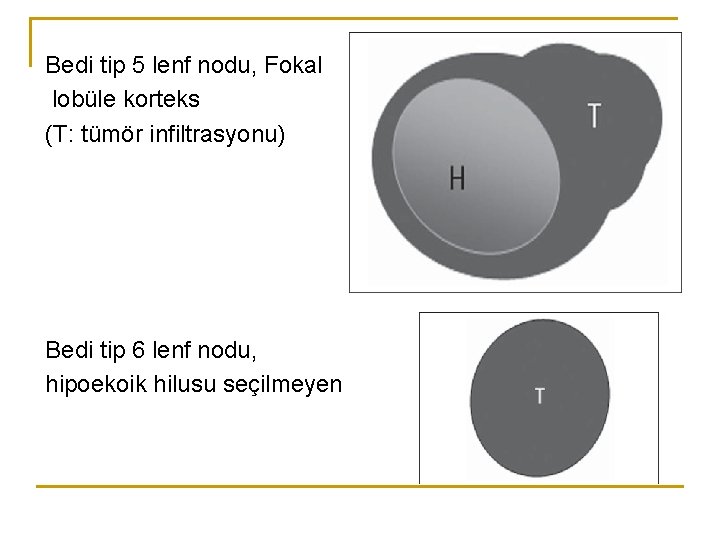 Bedi tip 5 lenf nodu, Fokal lobüle korteks (T: tümör infiltrasyonu) Bedi tip 6 Bedi tip 5 lenf nodu, Fokal lobüle korteks (T: tümör infiltrasyonu) Bedi tip 6