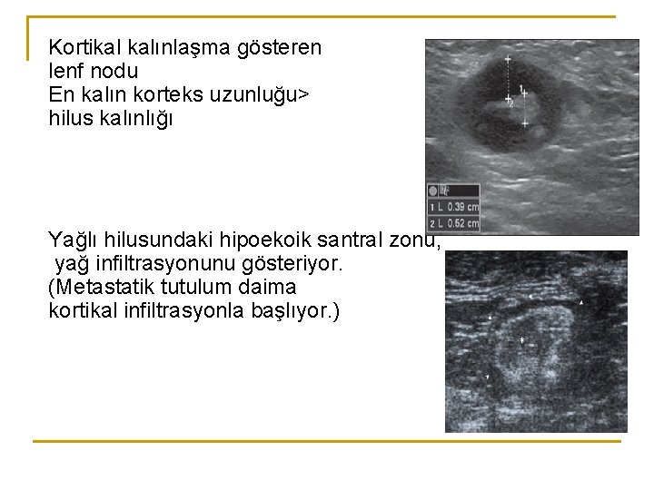 Kortikal kalınlaşma gösteren lenf nodu En kalın korteks uzunluğu> hilus kalınlığı Yağlı hilusundaki hipoekoik Kortikal kalınlaşma gösteren lenf nodu En kalın korteks uzunluğu> hilus kalınlığı Yağlı hilusundaki hipoekoik