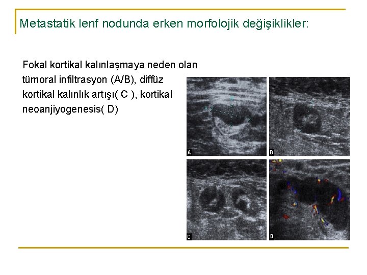 Metastatik lenf nodunda erken morfolojik değişiklikler: Fokal kortikal kalınlaşmaya neden olan tümoral infiltrasyon (A/B), Metastatik lenf nodunda erken morfolojik değişiklikler: Fokal kortikal kalınlaşmaya neden olan tümoral infiltrasyon (A/B),